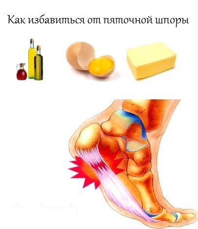 Как избавиться от пяточной шпоры навсегда. Как избавиться от шпоры. Избавление от пяточной шпоры. Как избавиться от пяточной шпоры.